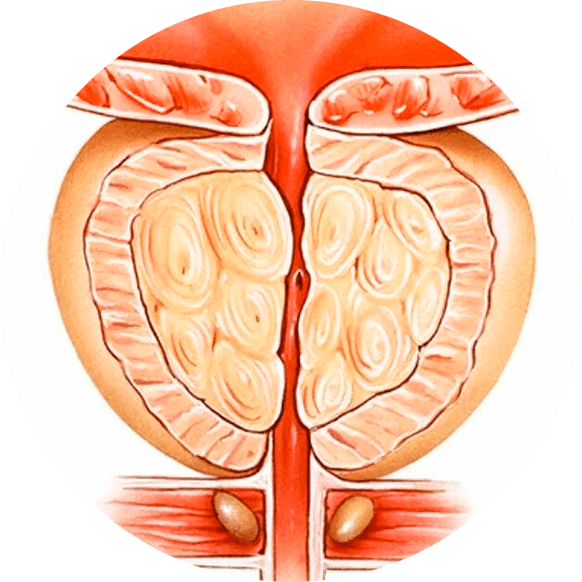 Conseguenze della prostatite non trattata
