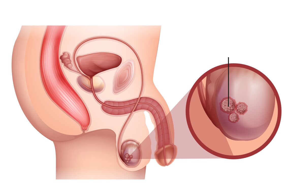 segni di cancro alla prostata