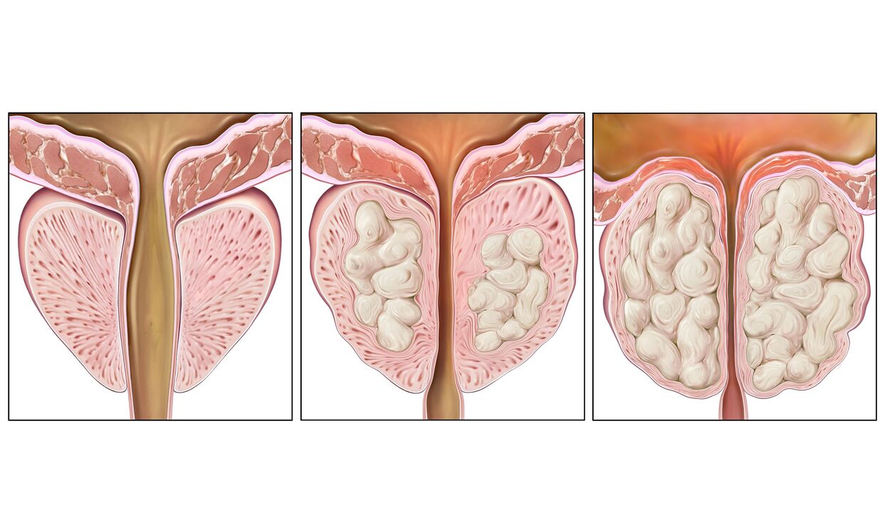 stadi del cancro alla prostata