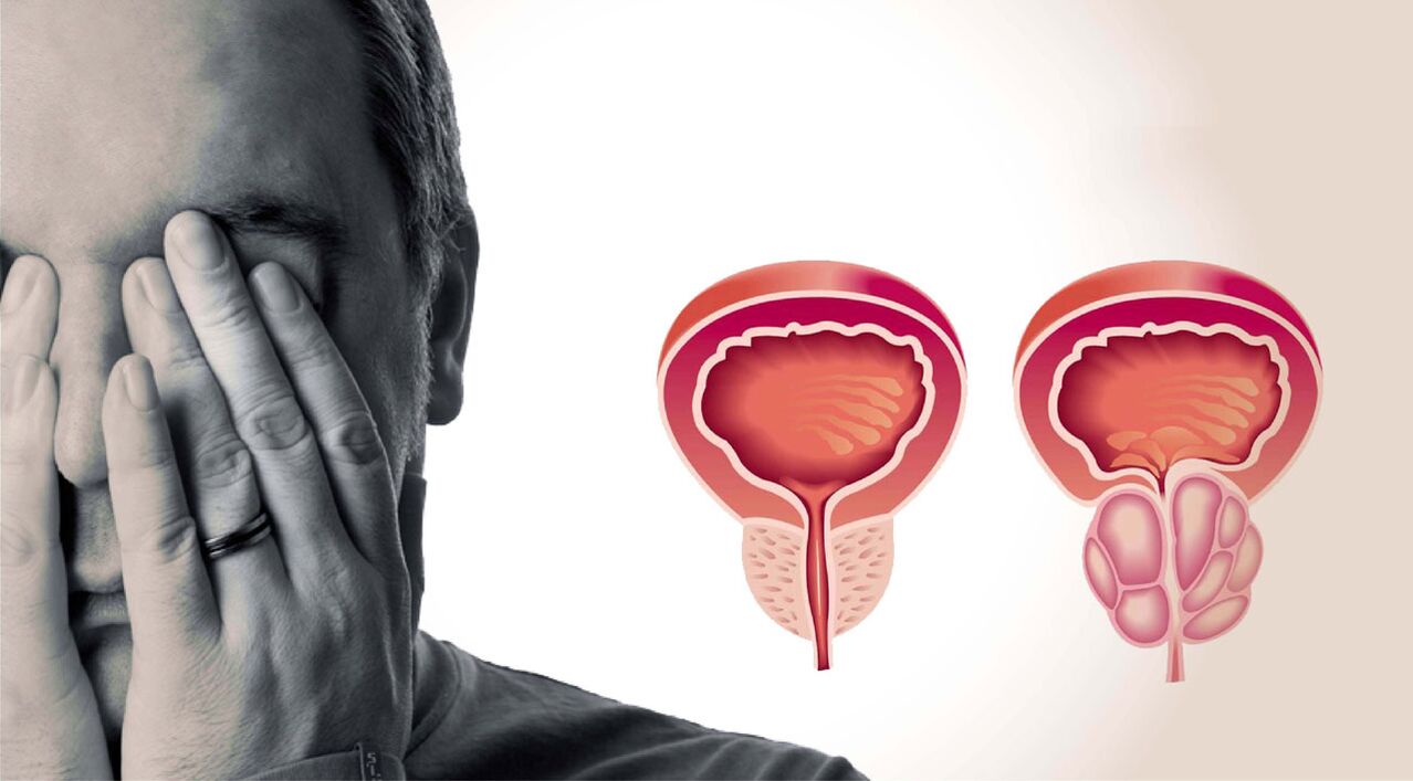 prostatite cronica negli uomini