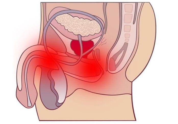 metodi di trattamento della prostatite